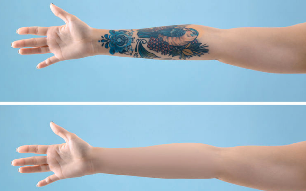 Onbeperkt tatoeage of permanente make-up verwijderen tot 100 cm² door Perfect You Skin Clinic!